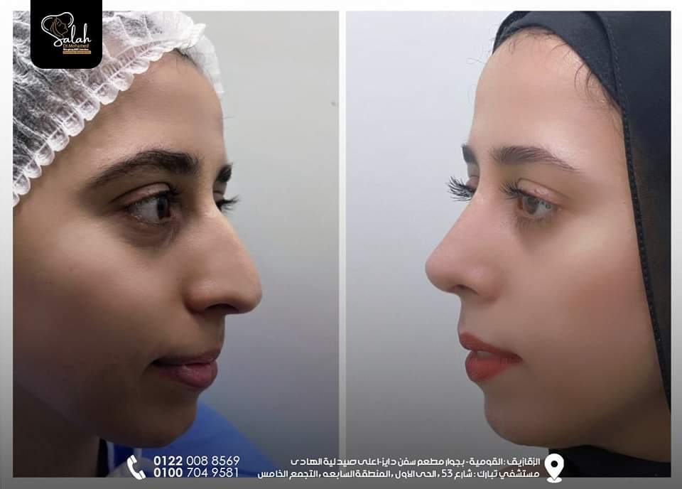 Crooked Nose Rhinoplasty